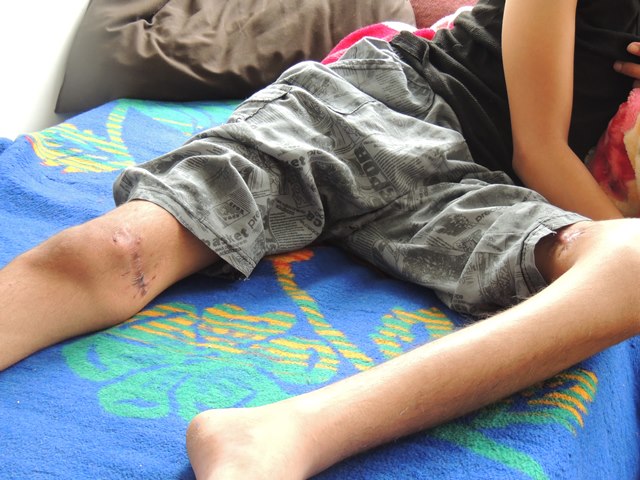 爆撃に巻き込まれ、背中の神経を損傷し、足を動かすことができなくなった少年。両足に手術の跡が残っている。(シリア人難民B女史が支援するクリニックにて。2014年5月筆者撮影)　(写真3)